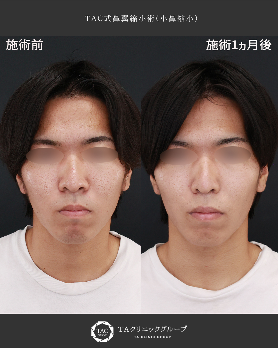 鼻翼縮小術│20代メンズ整形