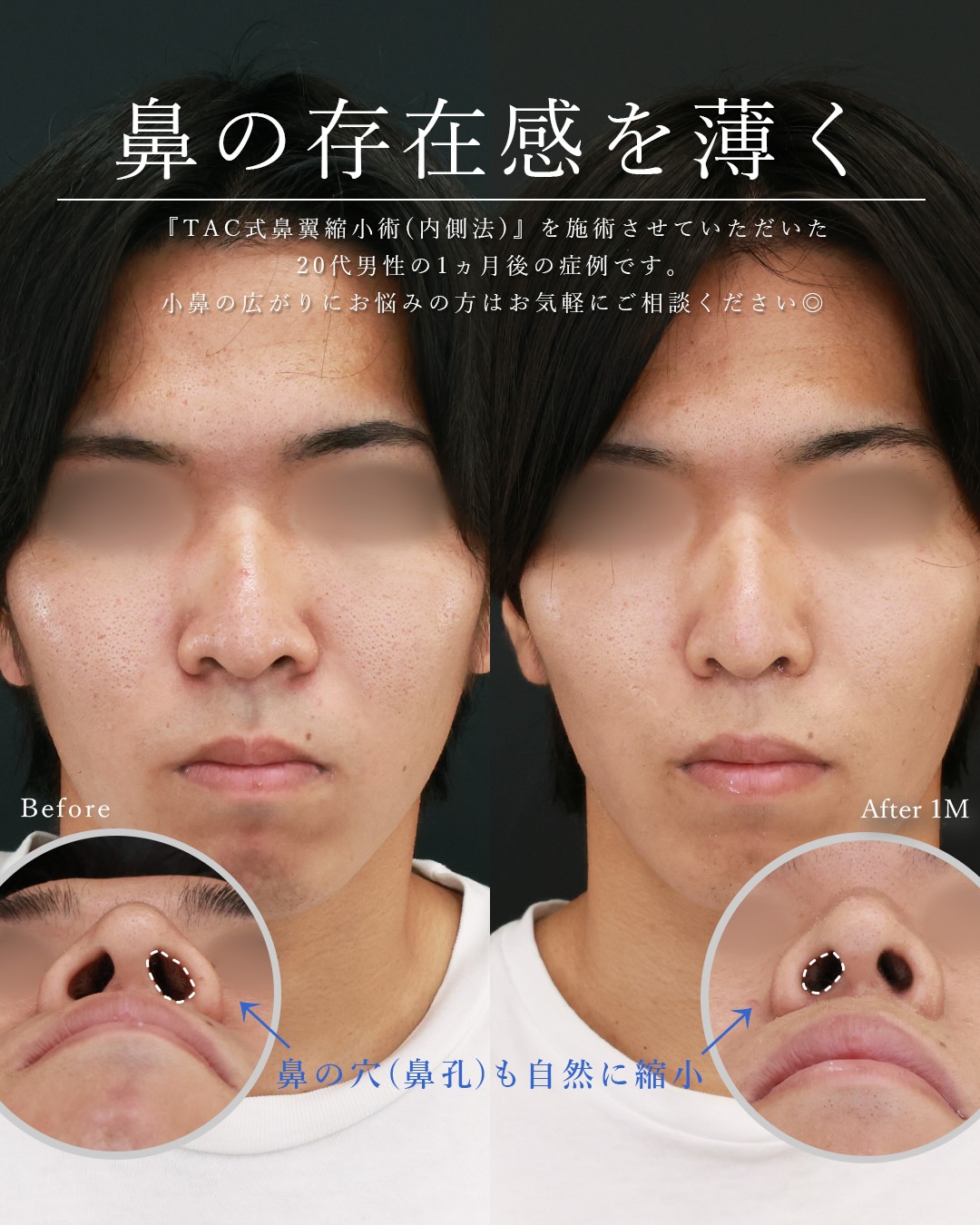 TAC式 鼻翼縮小術（小鼻縮小）の症例写真 施術前後 