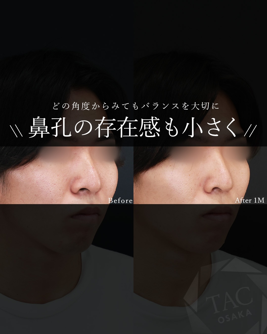 TAC式 鼻翼縮小術（小鼻縮小）の症例写真 施術前後 