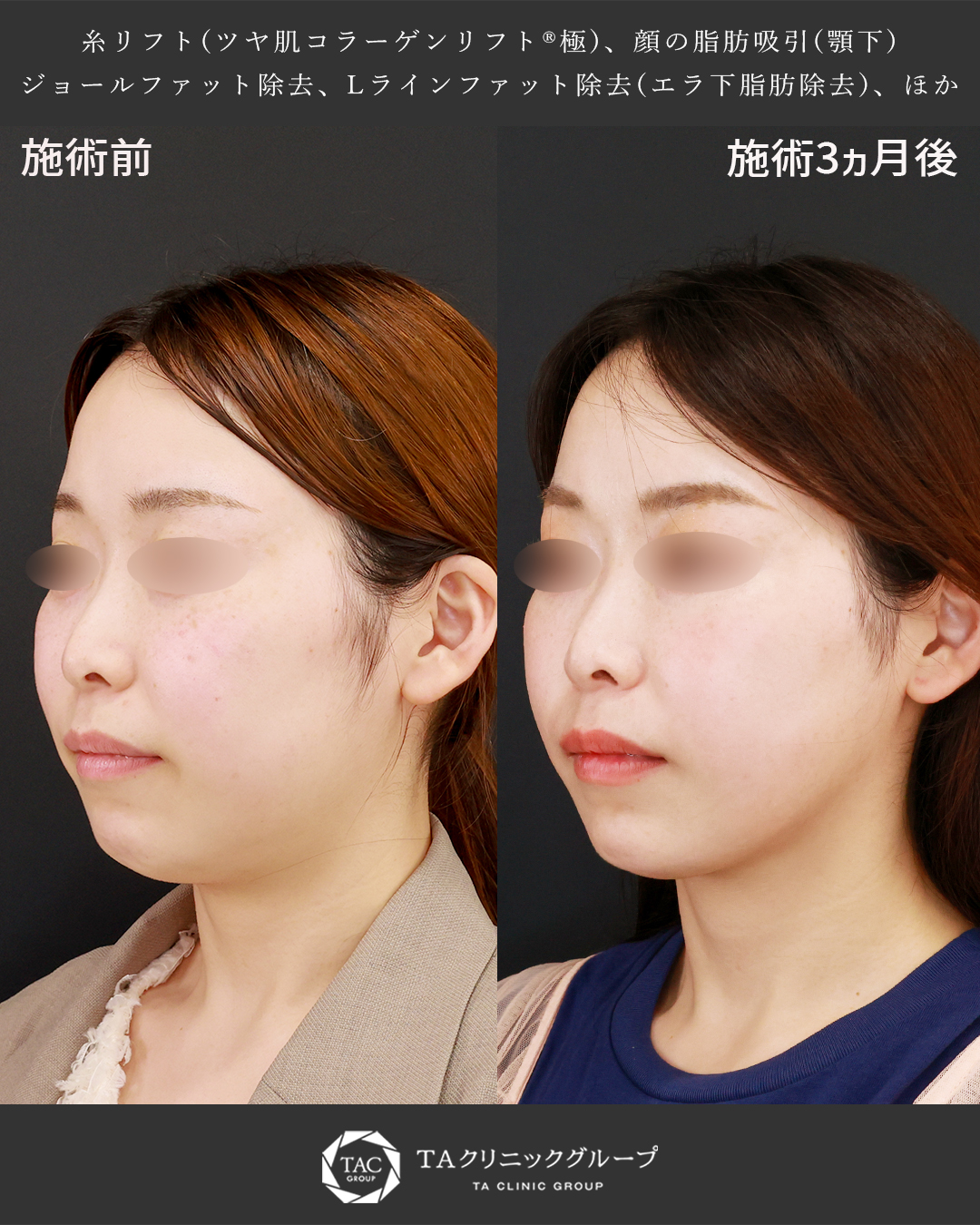 20代女性│糸リフト×脂肪吸引で輪郭すっきり！