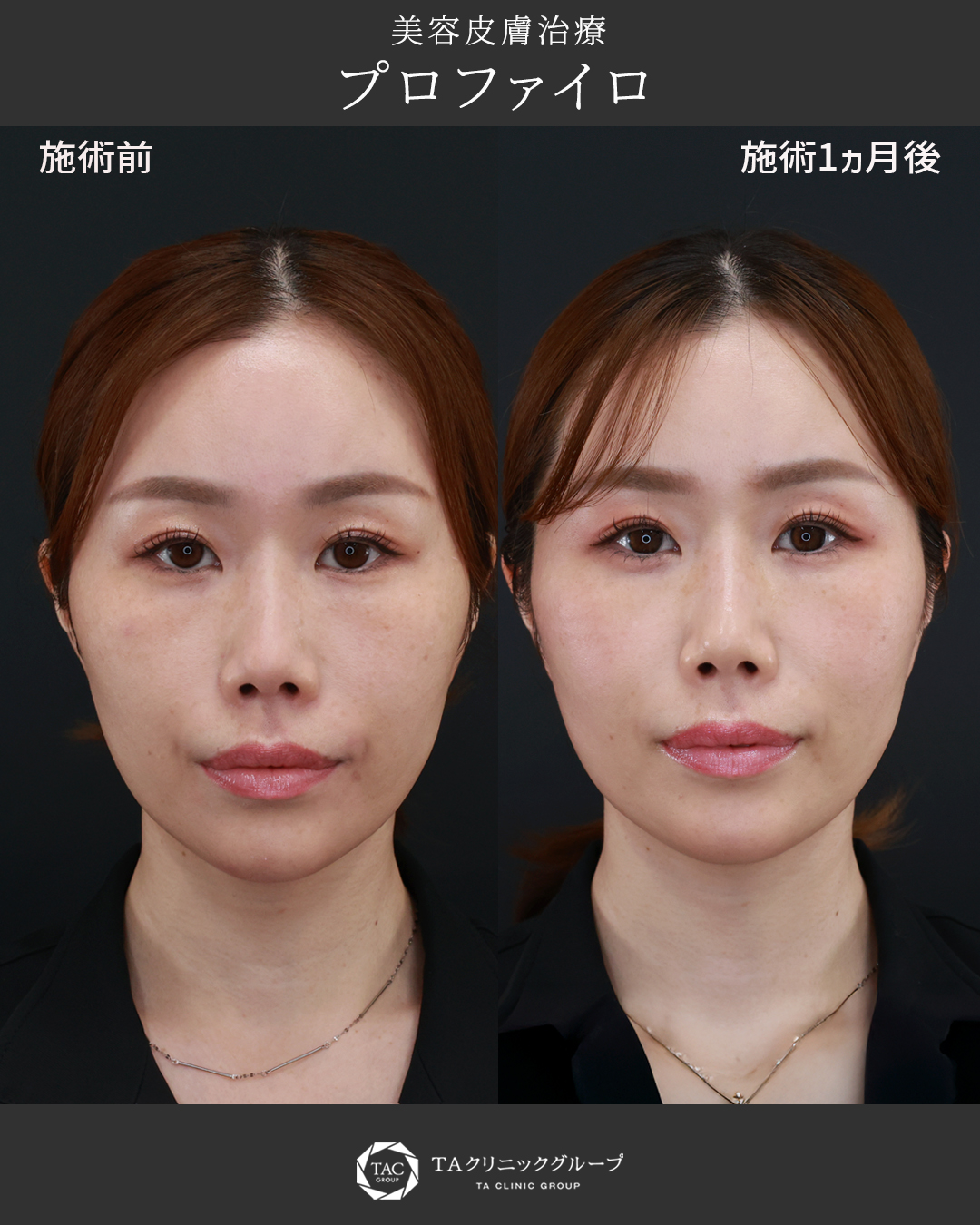 【プロファイロ】頬コケと肌質の改善症例
