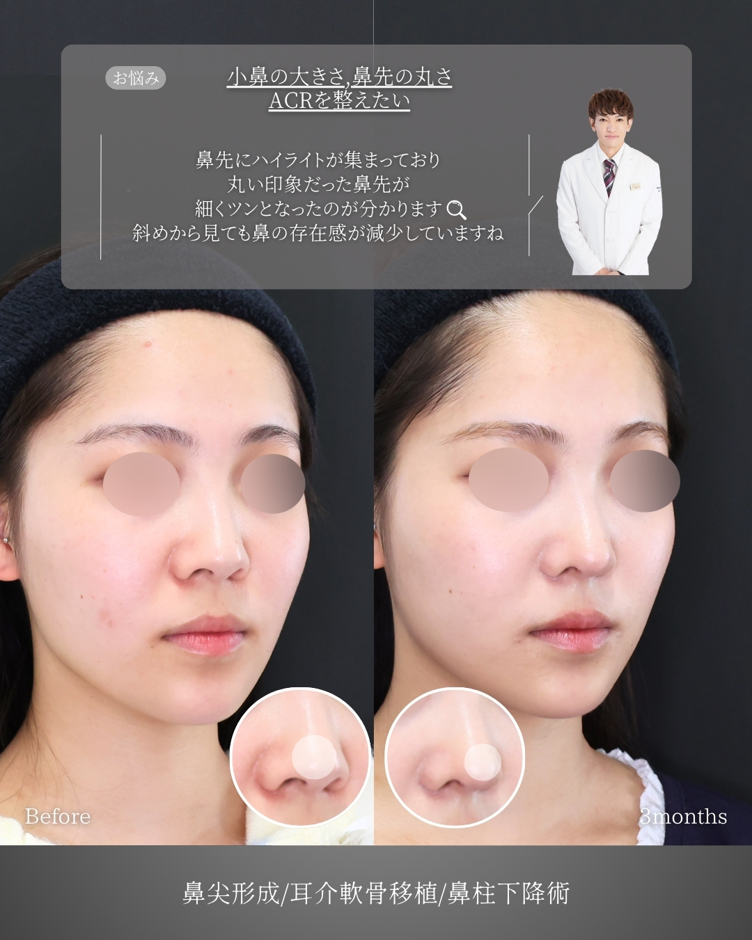 鼻尖形成・鼻尖縮小/鼻先軟骨移植の症例写真 施術前後 