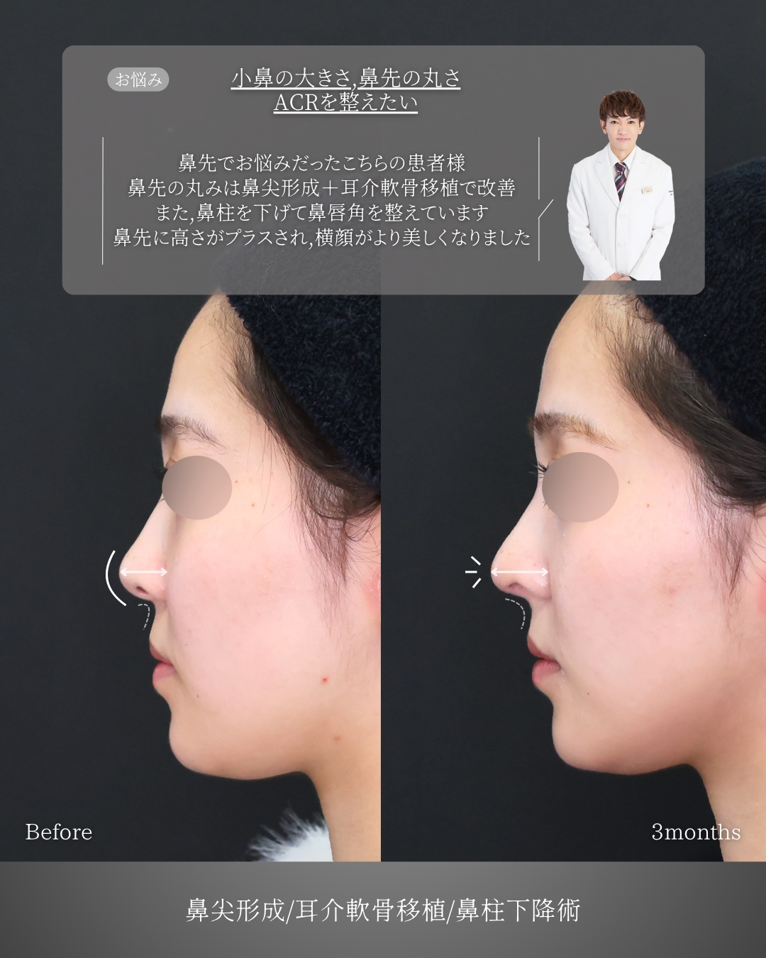鼻尖形成・鼻尖縮小/鼻先軟骨移植の症例写真 施術前後 