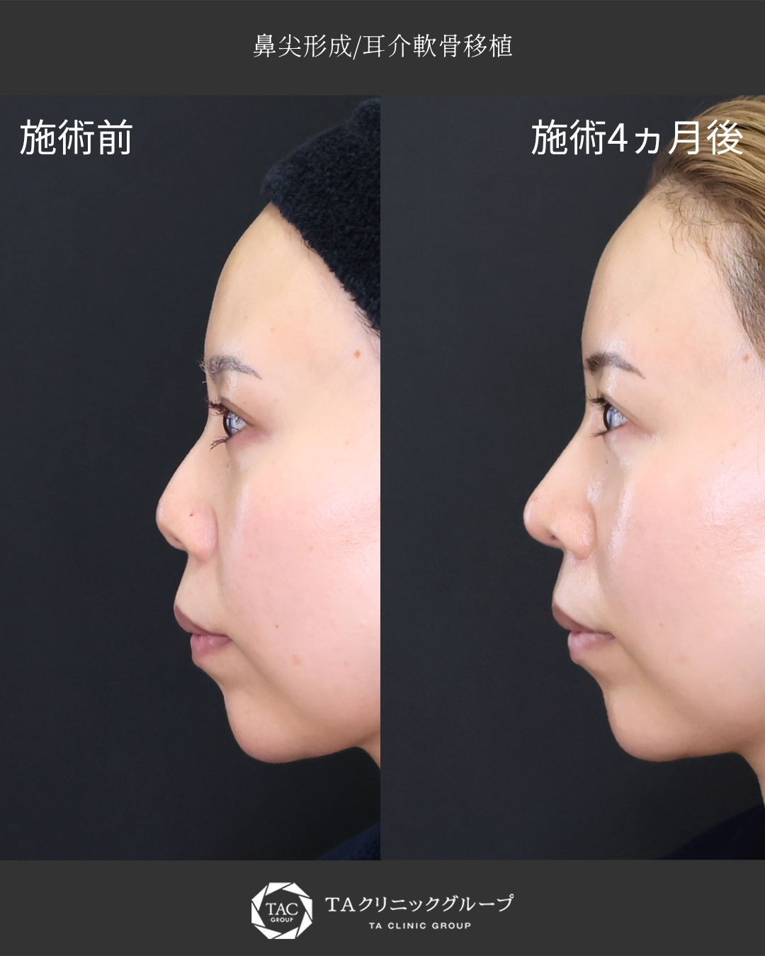 【鼻整形】｜鼻尖形成＋耳介軟骨移植で自然に鼻先を整える◎