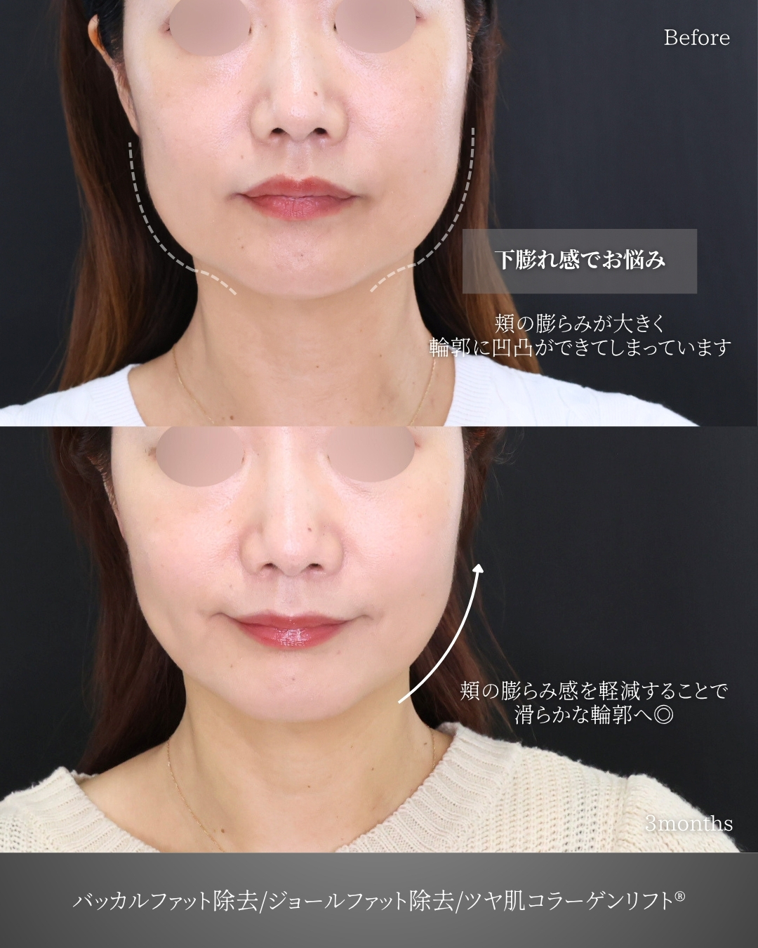 バッカルファット除去/TAC式 ツヤ肌コラーゲンリフト®の症例写真 施術前後 