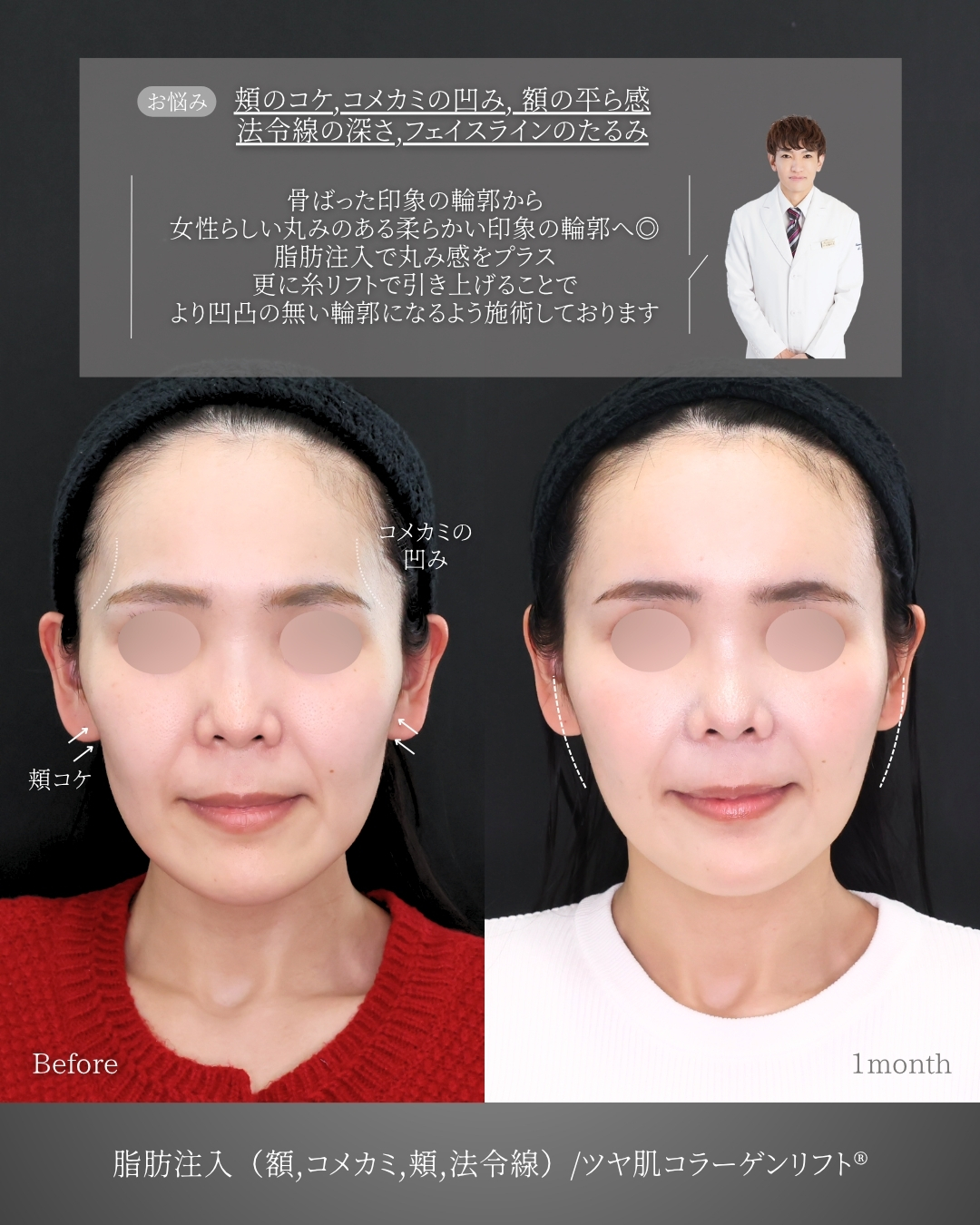 おでこの脂肪注入（オルチャンデコ形成）/顔の脂肪注入(コンデンスリッチフェイス)/TAC式 ツヤ肌コラーゲンリフト®の症例写真 施術前後 