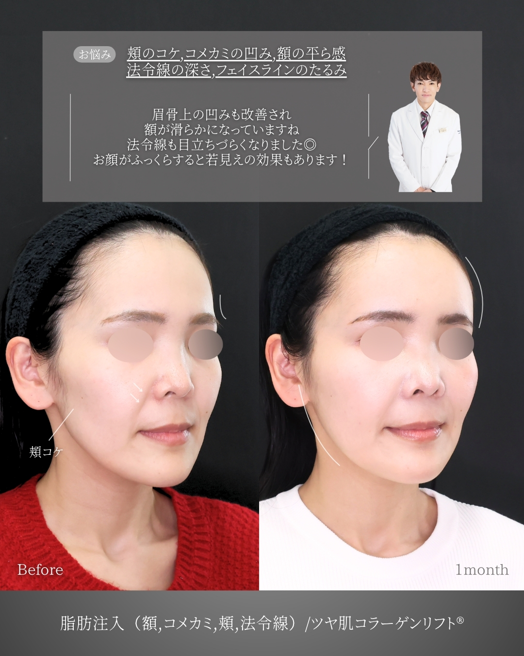 おでこの脂肪注入（オルチャンデコ形成）/顔の脂肪注入(コンデンスリッチフェイス)/TAC式 ツヤ肌コラーゲンリフト®の症例写真 施術前後 