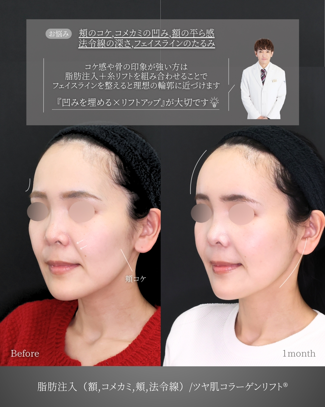 おでこの脂肪注入（オルチャンデコ形成）/顔の脂肪注入(コンデンスリッチフェイス)/TAC式 ツヤ肌コラーゲンリフト®の症例写真 施術前後 