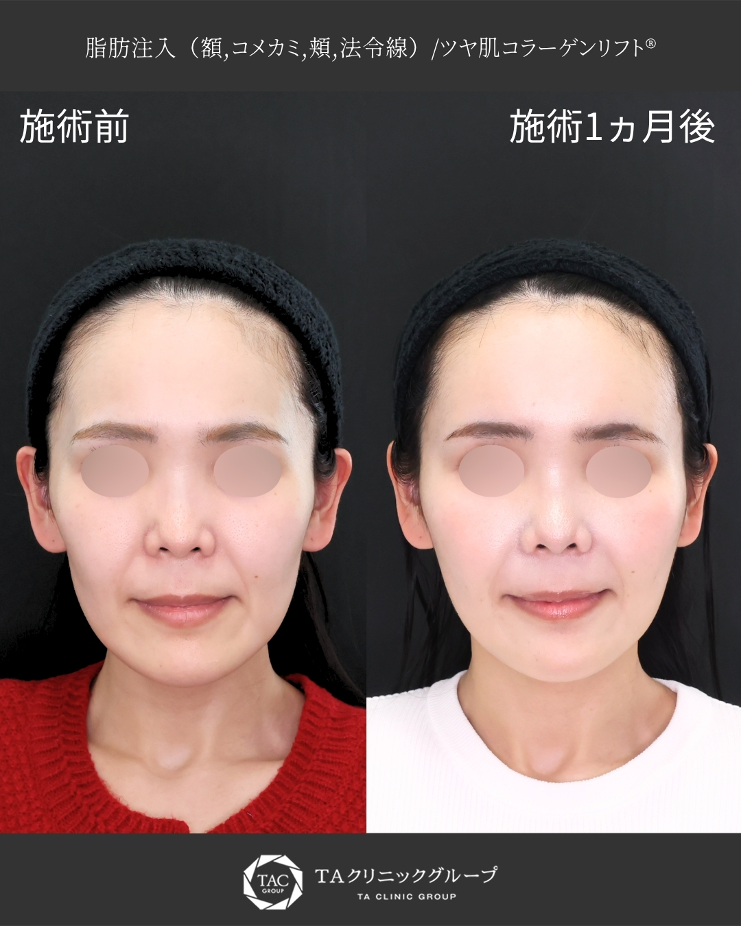 【脂肪注入×糸リフト】｜女性らしい丸みのある柔らかい印象の輪郭へ◎