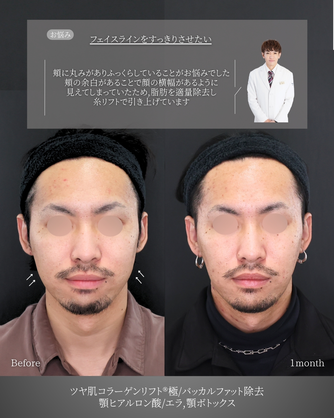 TAC式 ツヤ肌コラーゲンリフト®/バッカルファット除去/顎のヒアルロン酸注射の症例写真 施術前後 