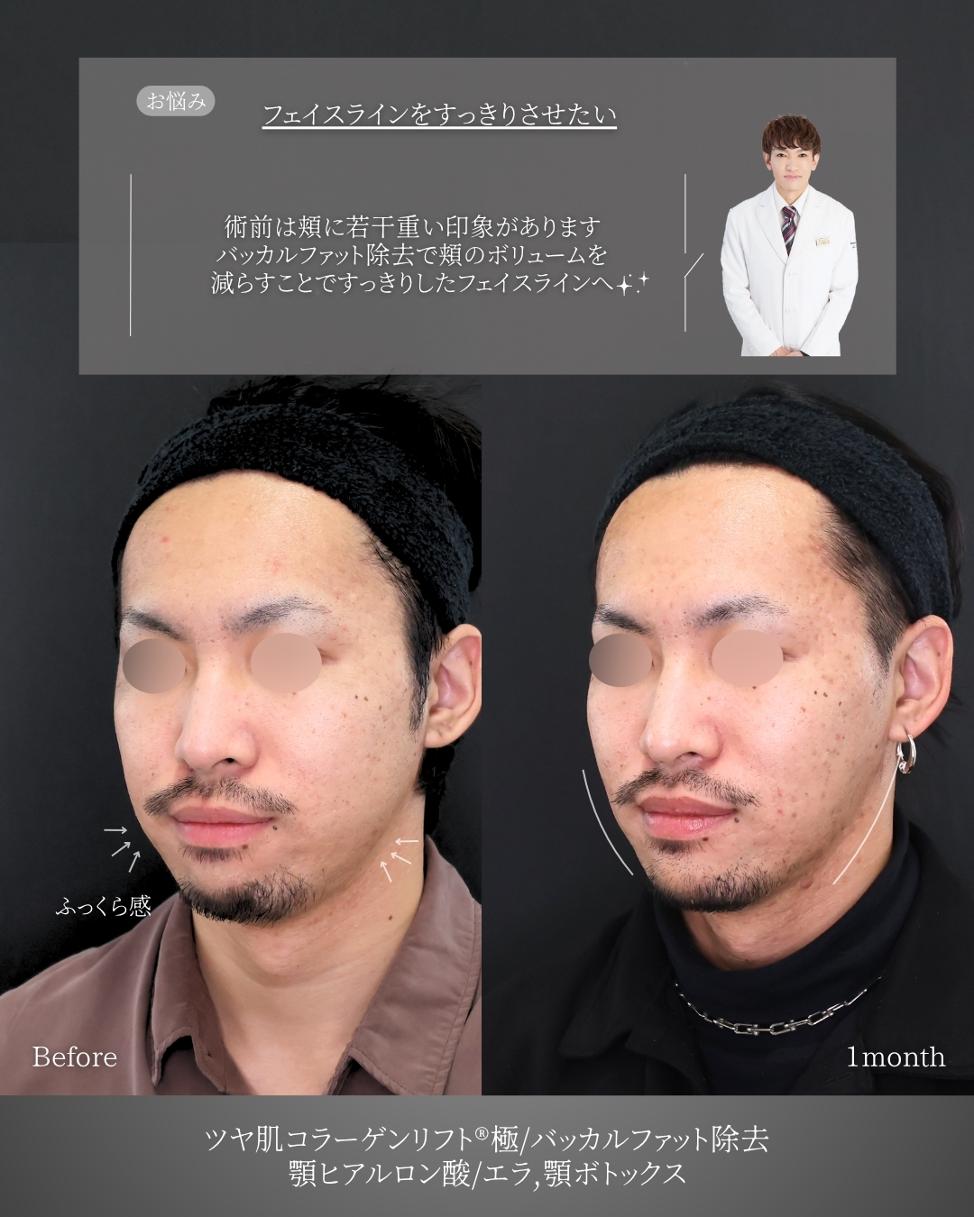 TAC式 ツヤ肌コラーゲンリフト®/バッカルファット除去/顎のヒアルロン酸注射の症例写真 施術前後 