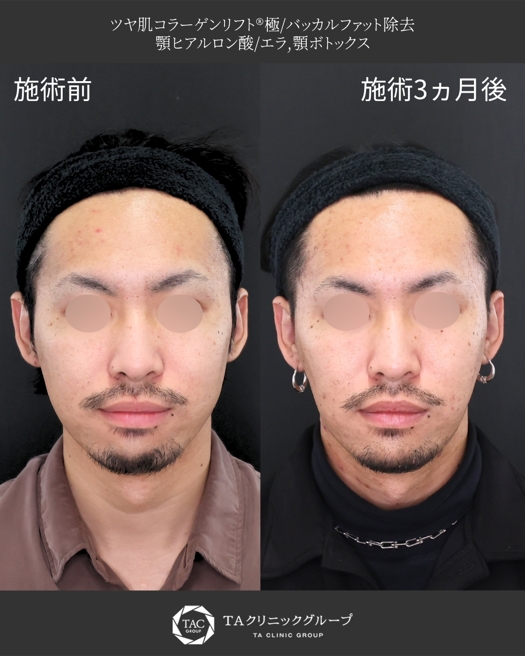 【糸リフト×脂肪除去】｜輪郭のふっくら感を減らすメンズ美容
