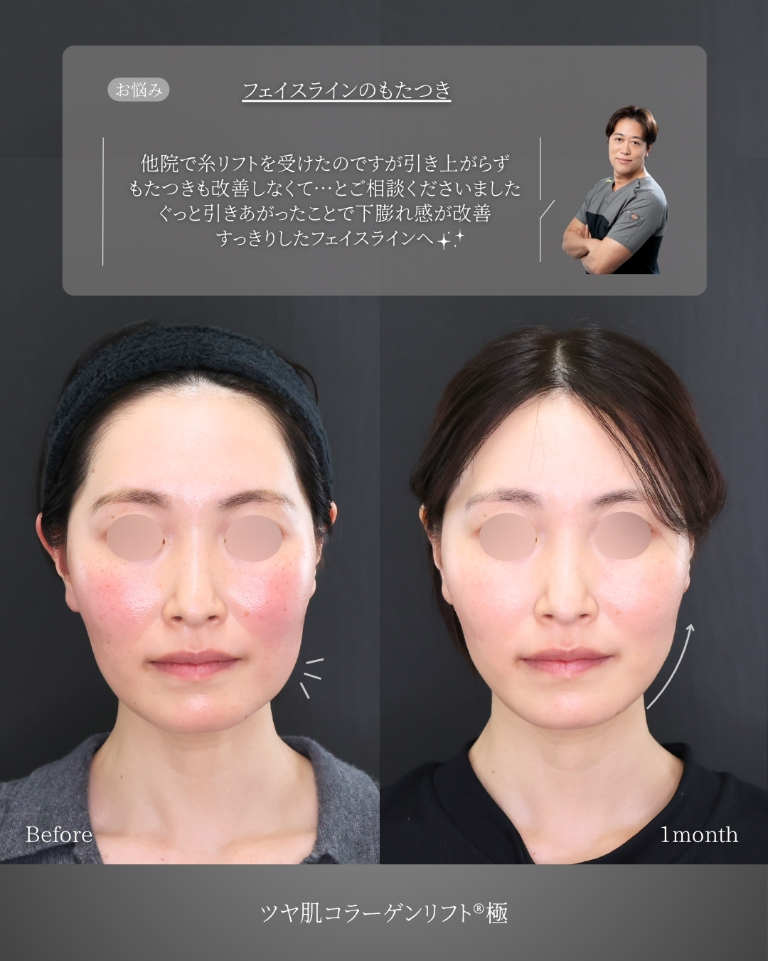 TAC式 ツヤ肌コラーゲンリフト®の症例写真 施術前後 