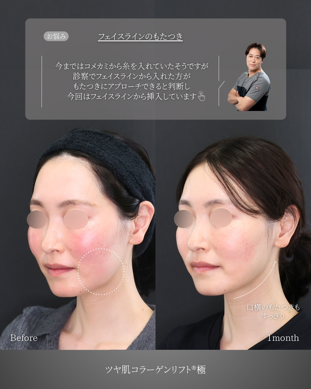 TAC式 ツヤ肌コラーゲンリフト®の症例写真 施術前後 