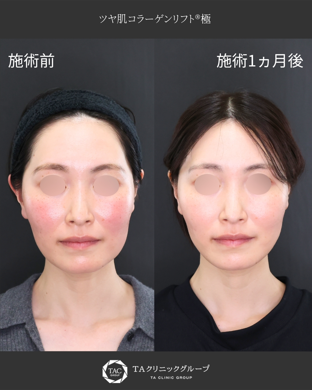 TAC式 ツヤ肌コラーゲンリフト®の症例写真 施術前後 