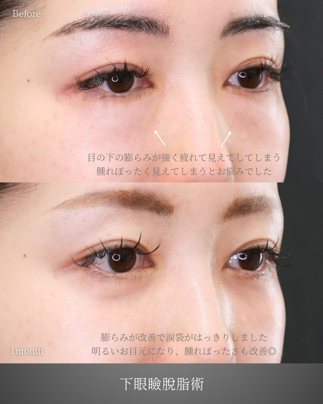 下眼瞼脱脂術（目の下のたるみ取り・目の下の脂肪ふくらみ取り）の症例写真 施術前後 