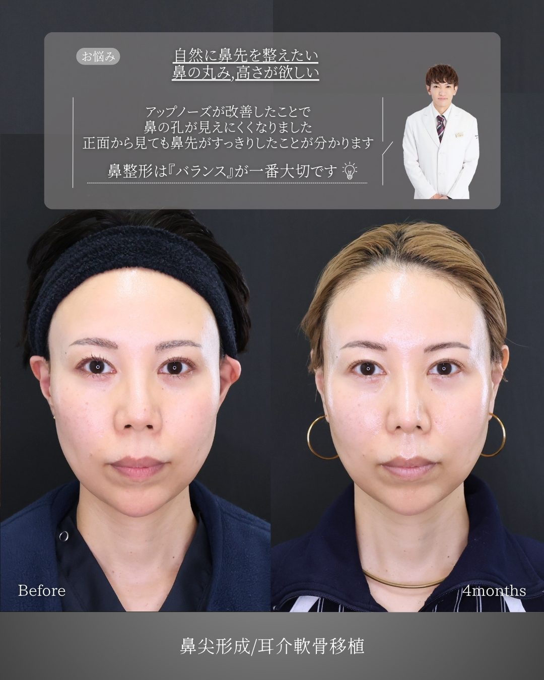 鼻尖形成・鼻尖縮小/鼻先軟骨移植の症例写真 施術前後 