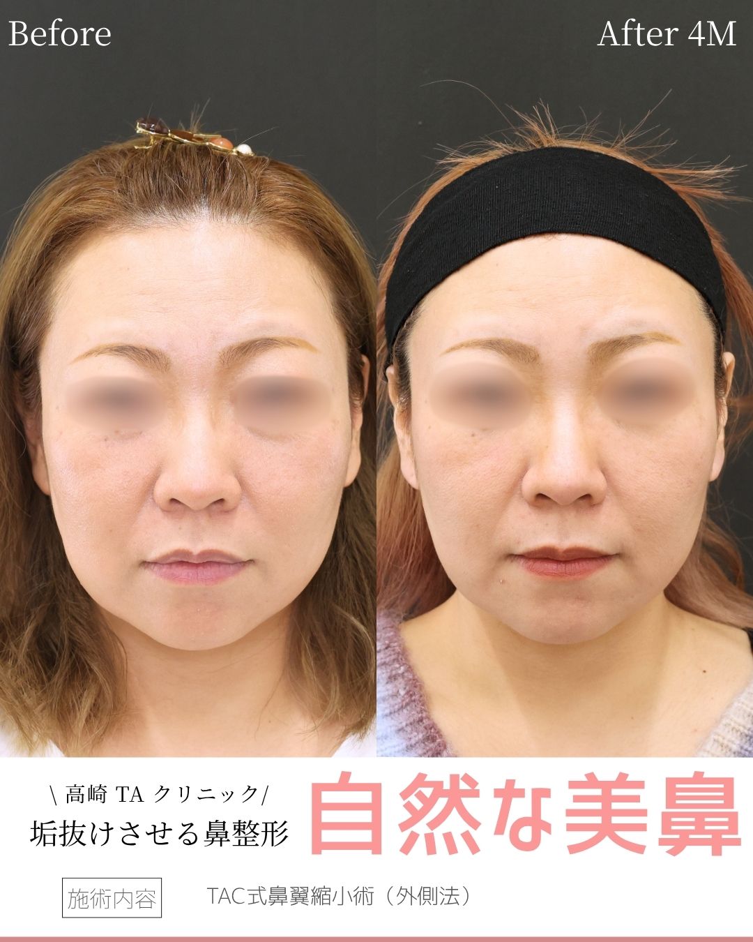 TAC式 鼻翼縮小術（小鼻縮小）の症例写真 施術前後 
