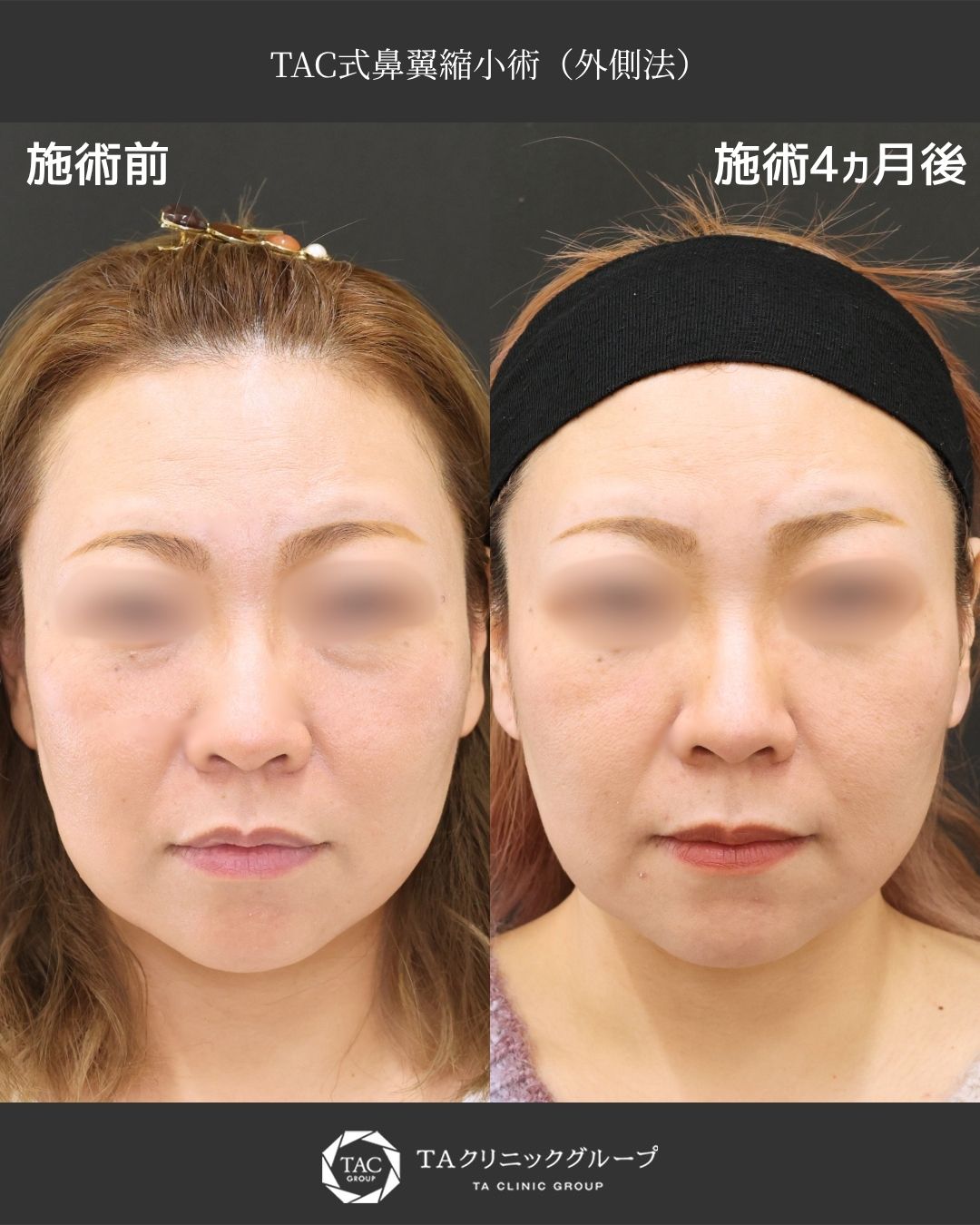 小鼻の広がりをさり気なく【鼻翼縮小術】でアプデ