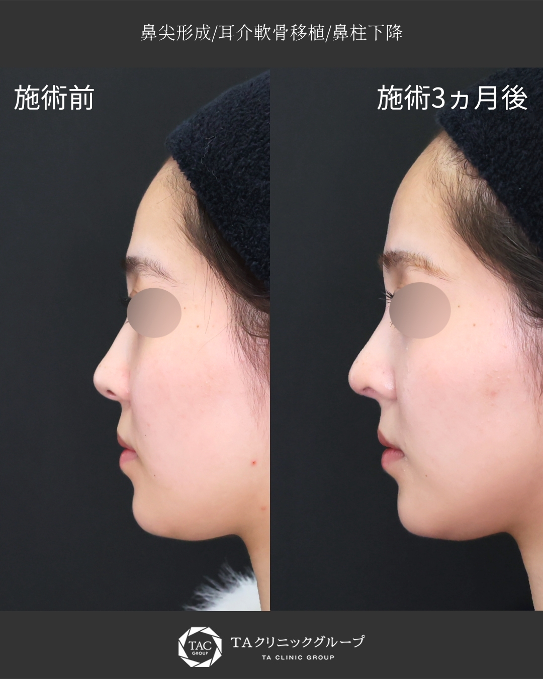 鼻尖形成・鼻尖縮小/鼻先軟骨移植の症例写真 施術前後 