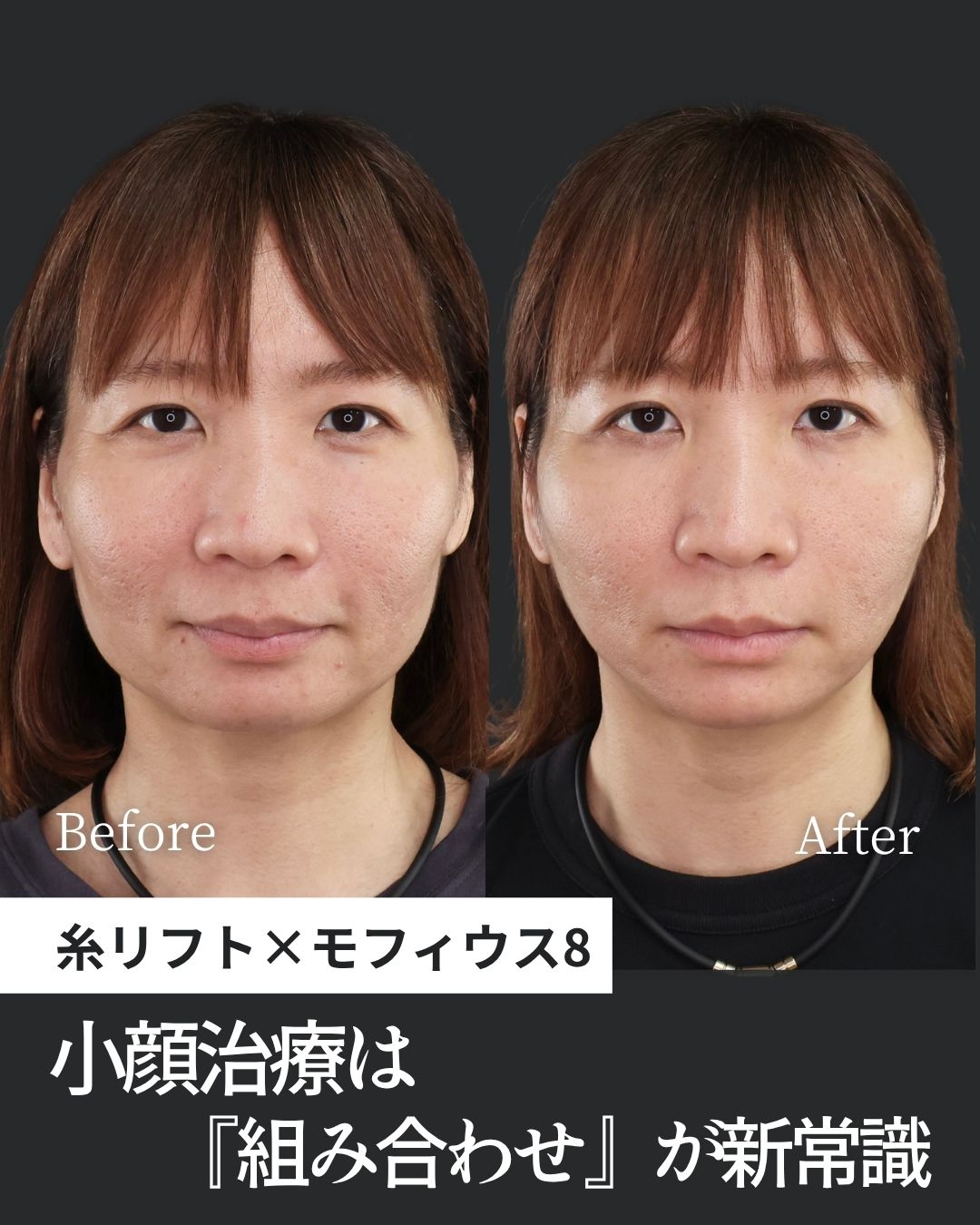 TAC式 ツヤ肌コラーゲンリフト®/モフィウス8/ヒアルロン酸注射：その他の症例写真 施術前後 