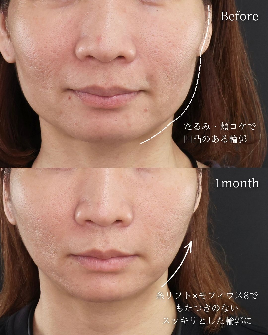 TAC式 ツヤ肌コラーゲンリフト®/モフィウス8/ヒアルロン酸注射：その他の症例写真 施術前後 