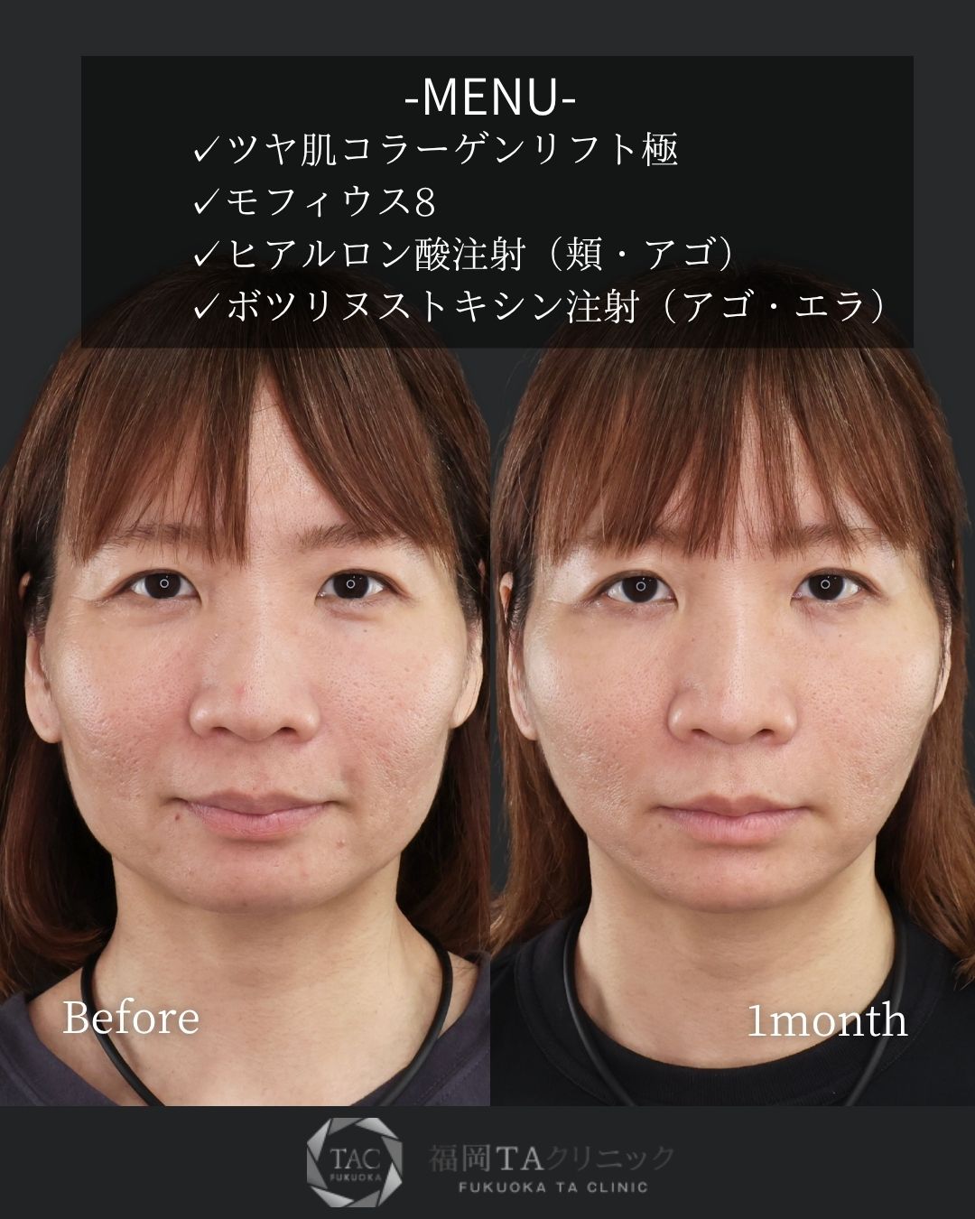 TAC式 ツヤ肌コラーゲンリフト®/モフィウス8/ヒアルロン酸注射：その他の症例写真 施術前後 