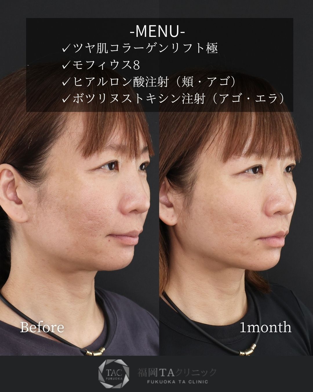TAC式 ツヤ肌コラーゲンリフト®/モフィウス8/ヒアルロン酸注射：その他の症例写真 施術前後 