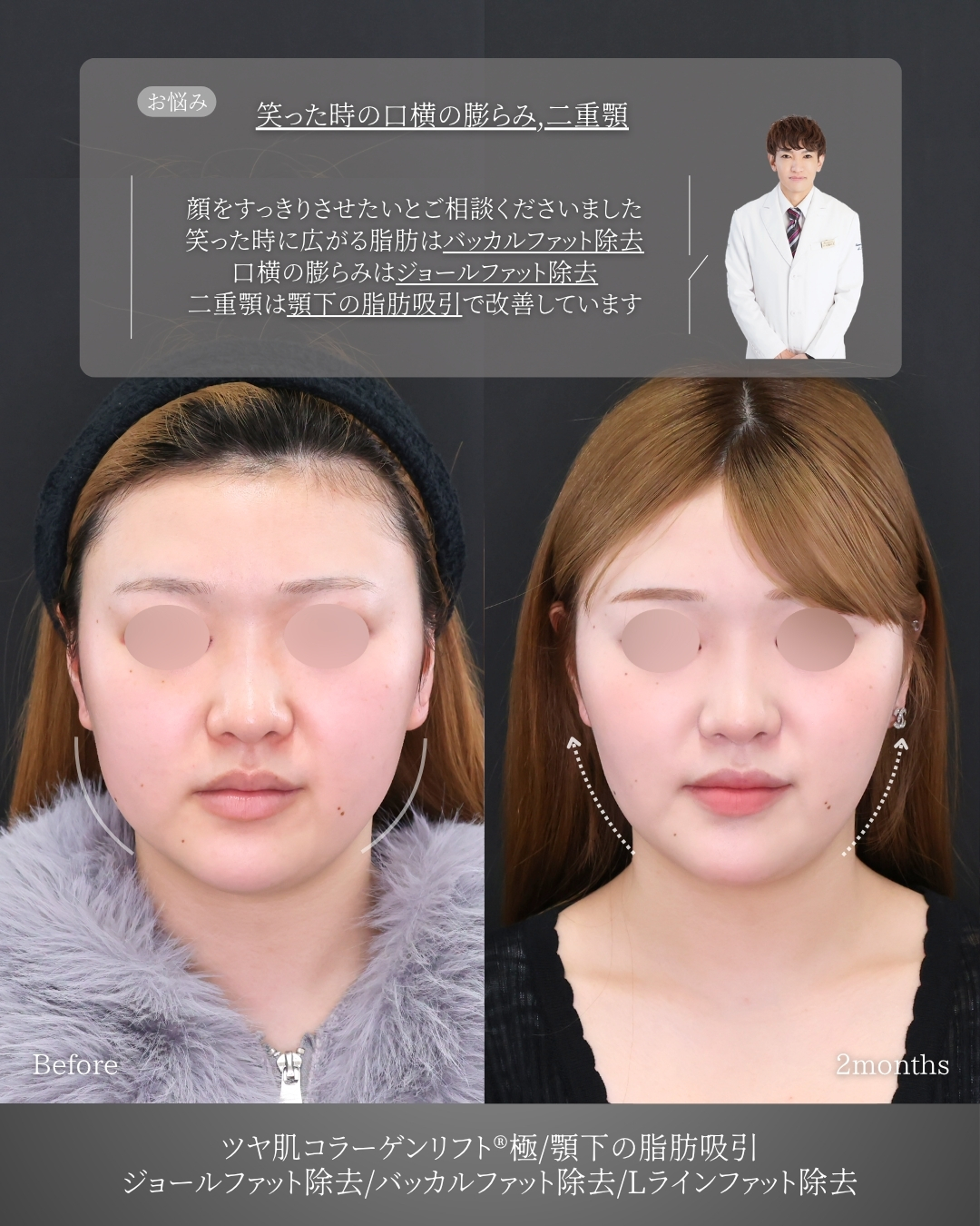TAC式 ツヤ肌コラーゲンリフト®/バッカルファット除去/ジョールファット除去の症例写真 施術前後 
