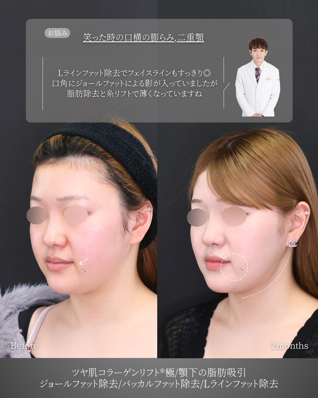 TAC式 ツヤ肌コラーゲンリフト®/バッカルファット除去/ジョールファット除去の症例写真 施術前後 