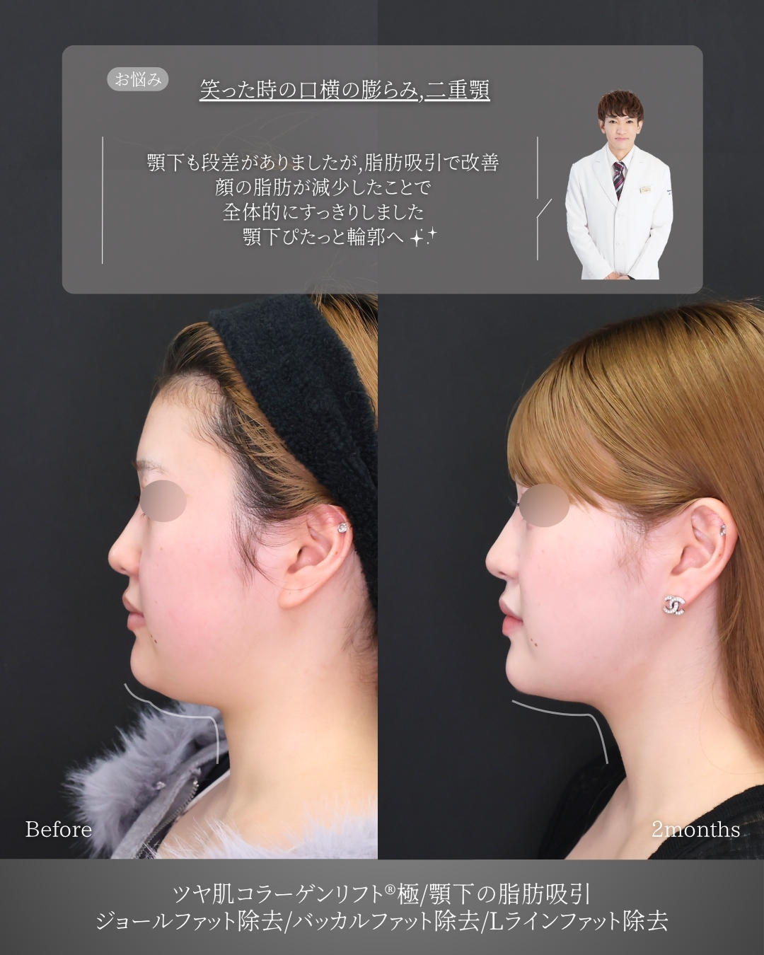 TAC式 ツヤ肌コラーゲンリフト®/バッカルファット除去/ジョールファット除去の症例写真 施術前後 