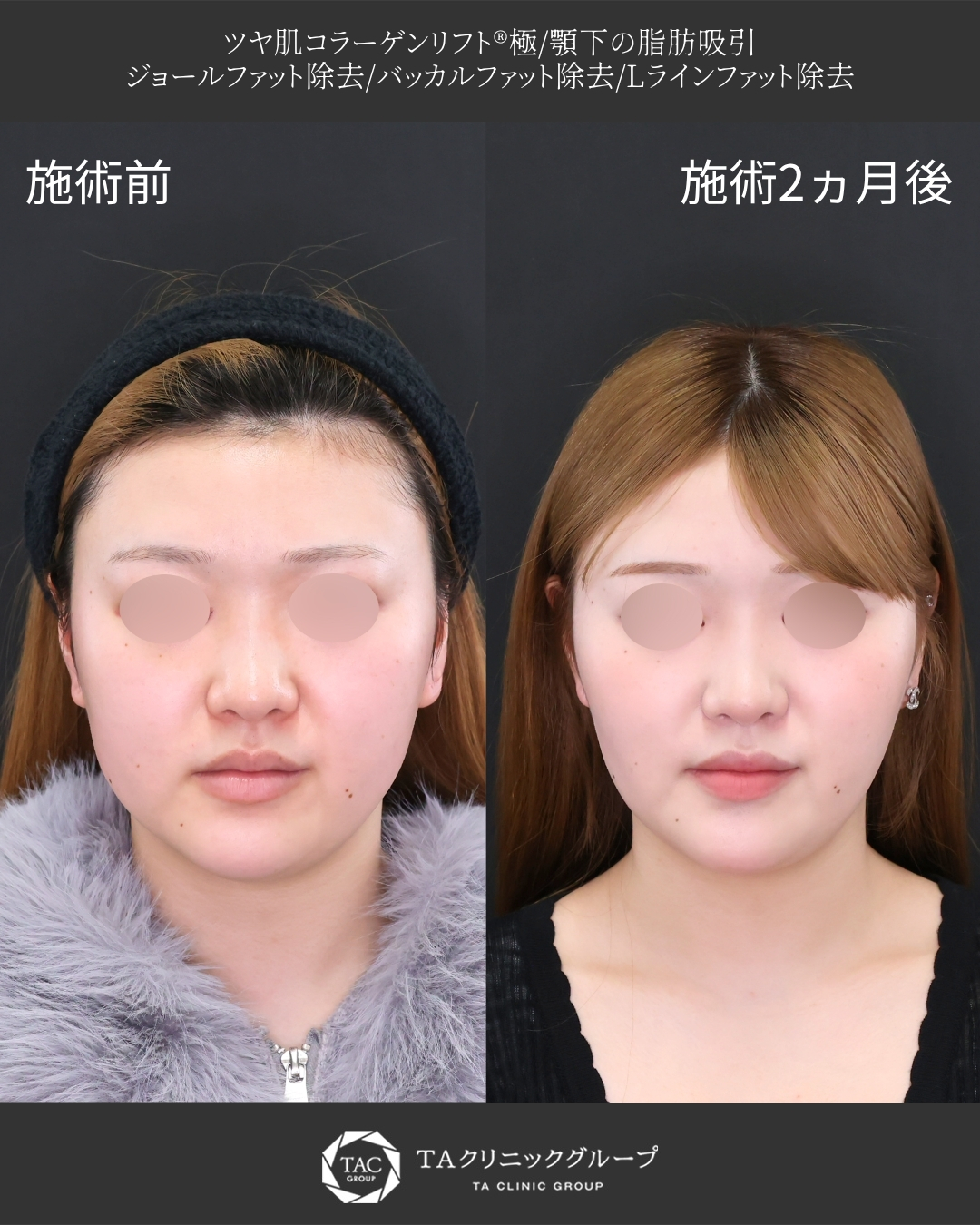 【脂肪除去×糸リフト】｜顔の余白感を減らして垢抜け輪郭へ