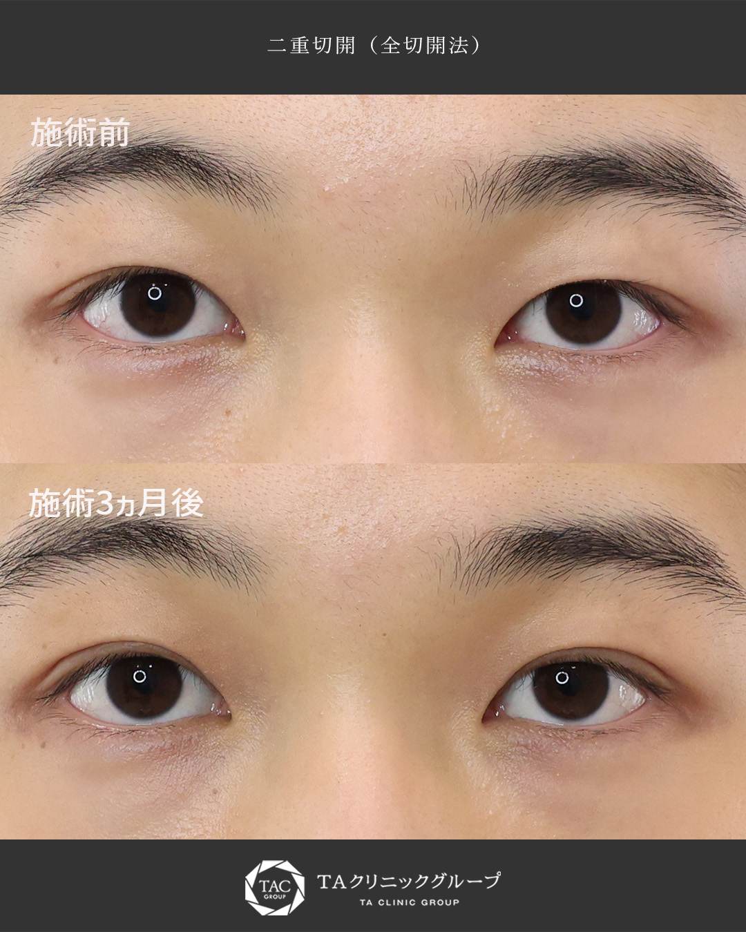 《埋没をしても取れてしまう…》切開に踏み切ったら世界が変わった