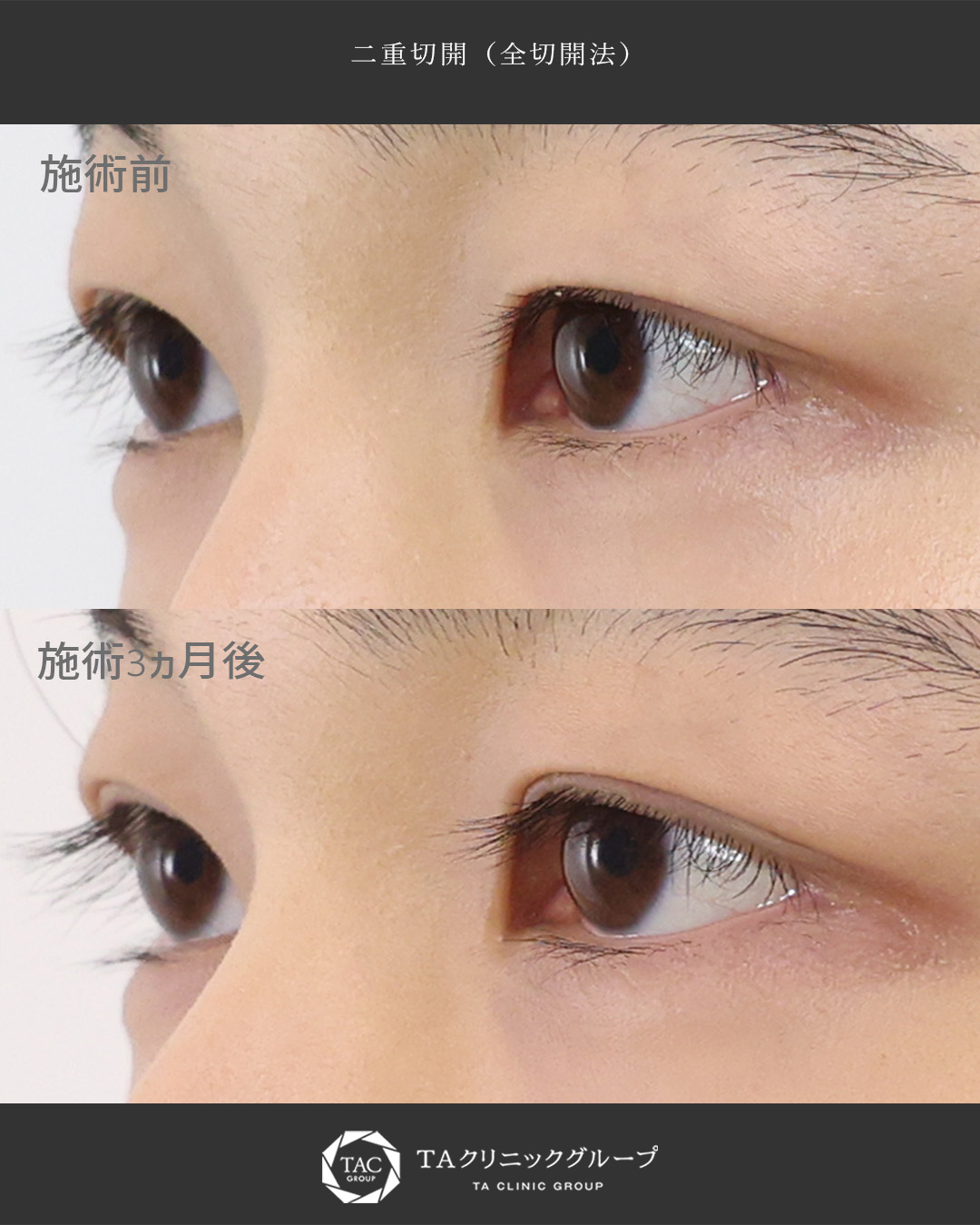二重切開（全切開法）の症例写真 施術前後 