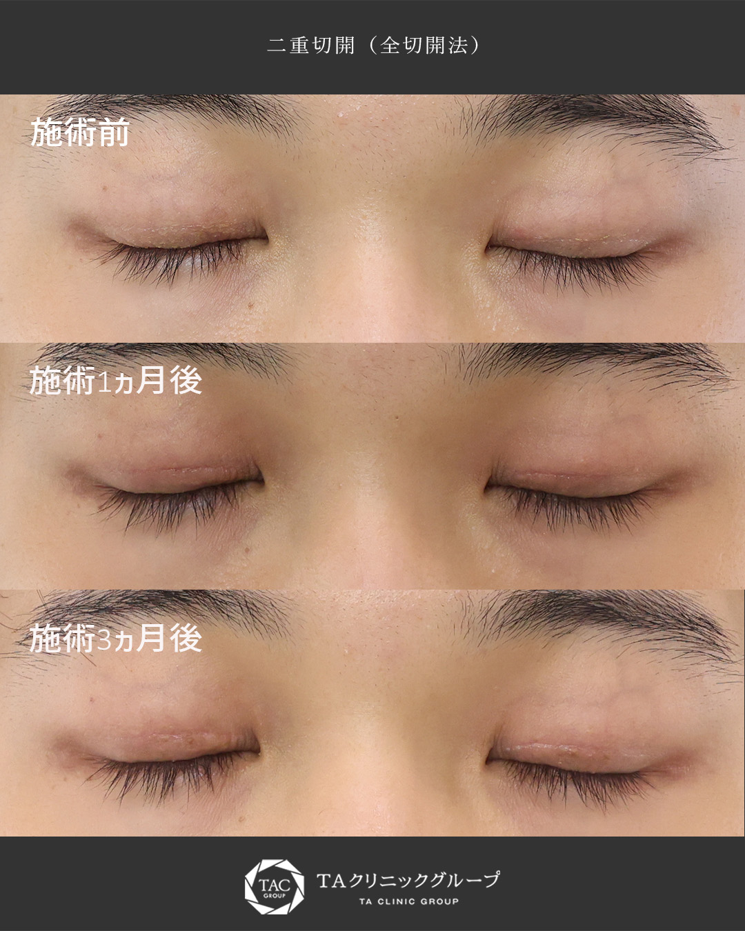 二重切開（全切開法）の症例写真 施術前後 