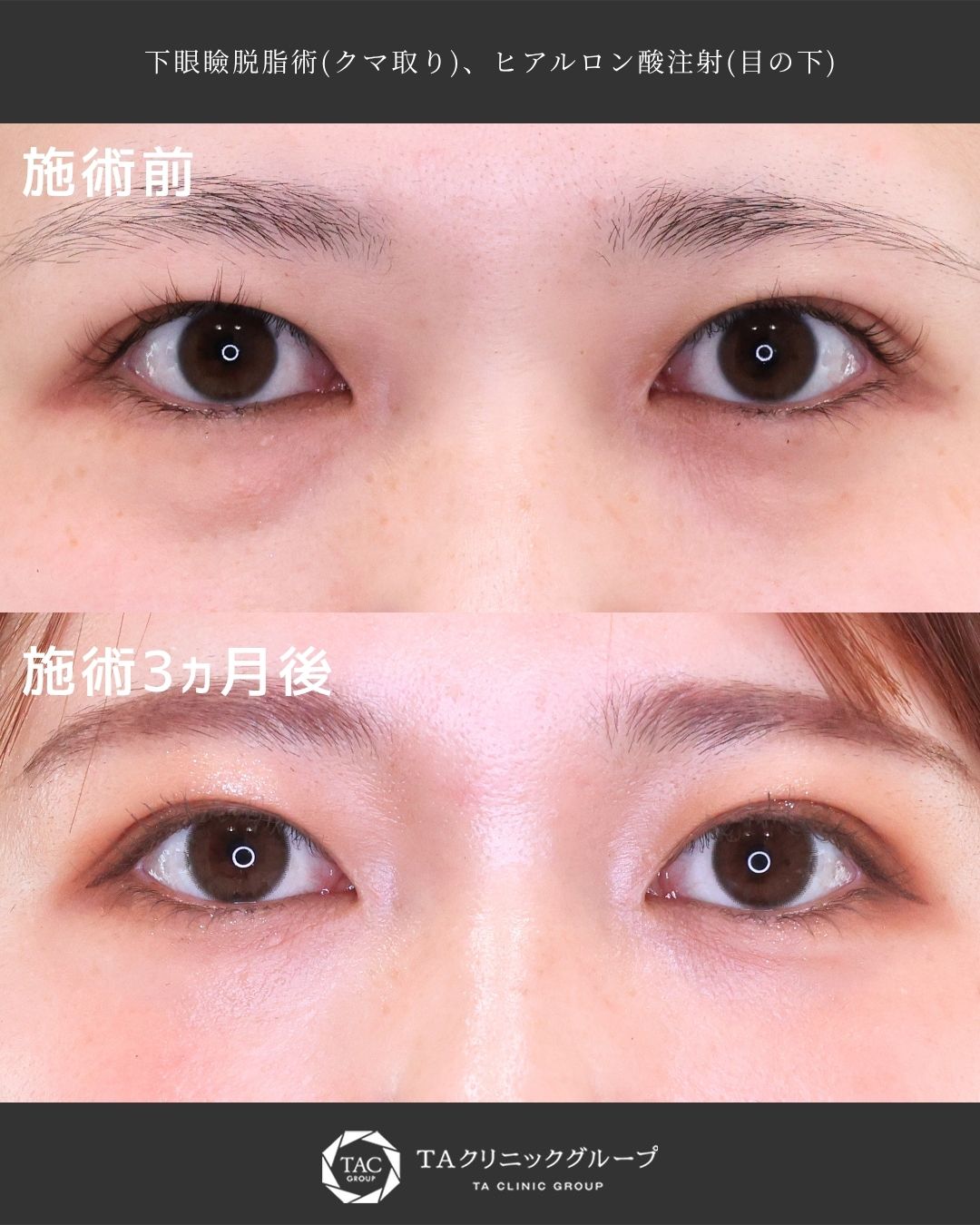 目の下のクマに10年悩んだ20代女性が出した答え◎