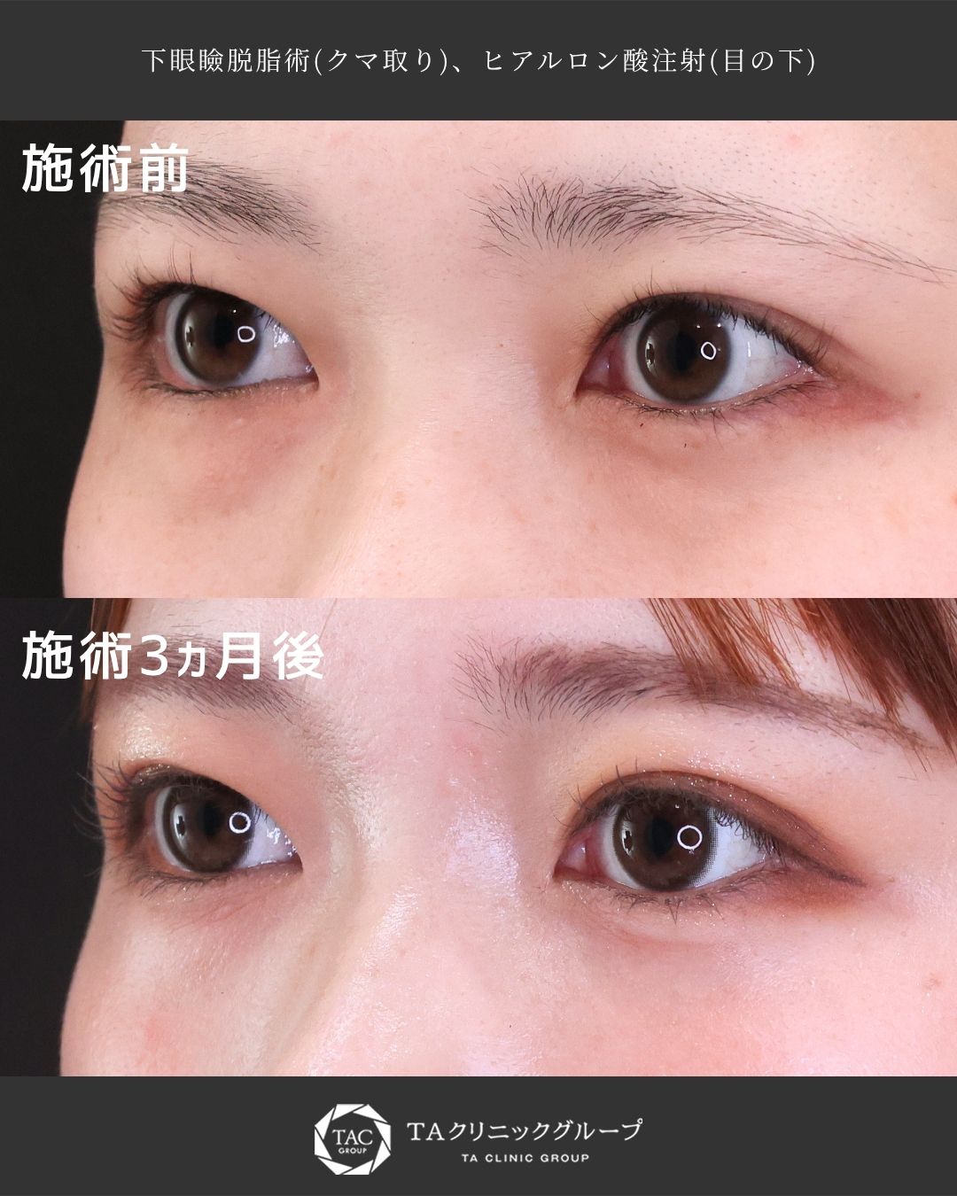 下眼瞼脱脂術（目の下のたるみ取り・目の下の脂肪ふくらみ取り）/ヒアルロン酸注射：その他の症例写真 施術前後 