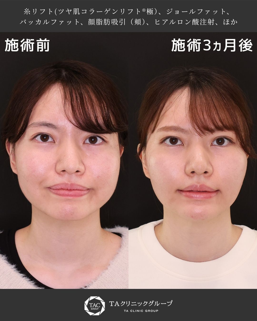 《5キロ痩せても変わらなかった顔が…》小顔術で別人級の変化！