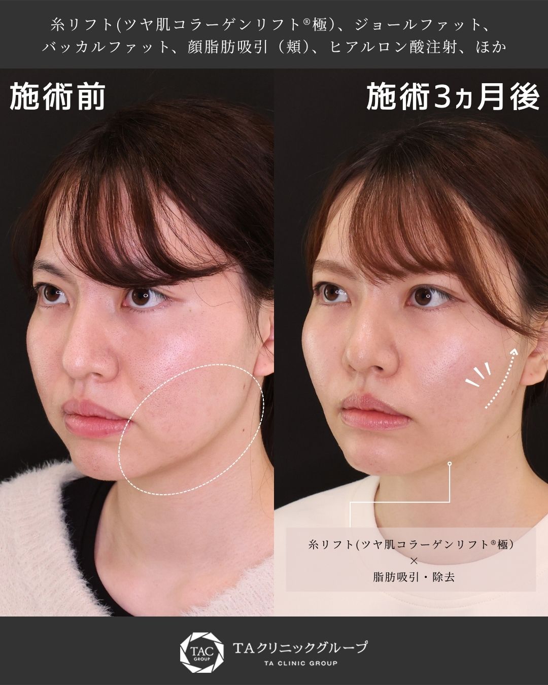 TAC式 ツヤ肌コラーゲンリフト®/バッカルファット除去/ジョールファット除去の症例写真 施術前後 