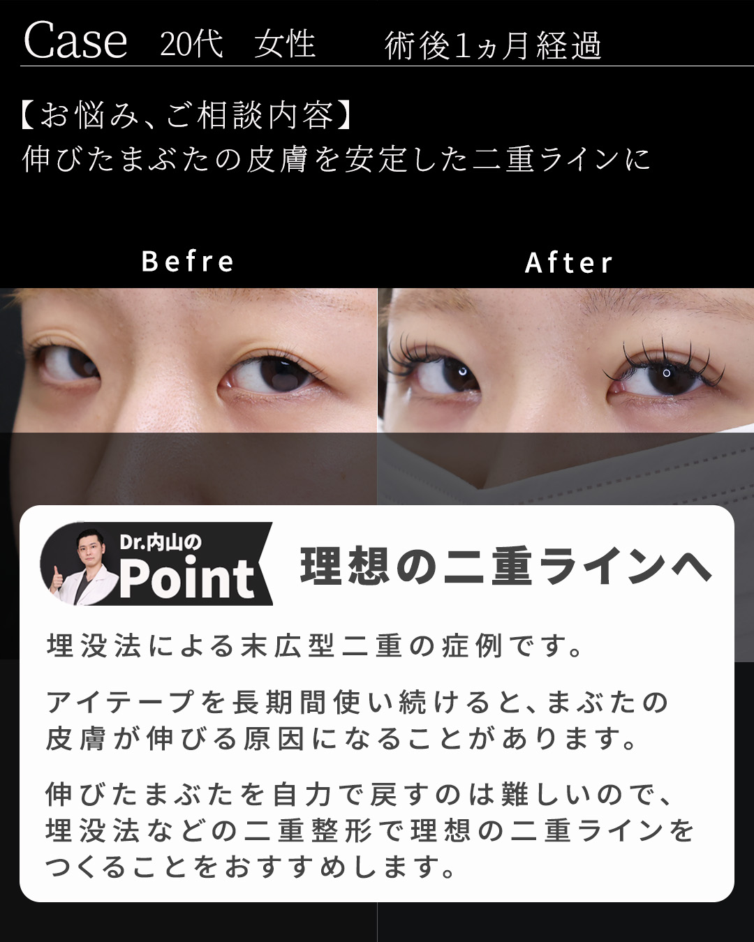 二重埋没法の症例写真 施術前後 