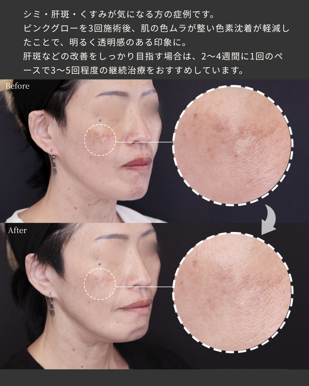 プルリアルデンシファイ/スキンバイブ（SKINVIVE）の症例写真 施術前後 