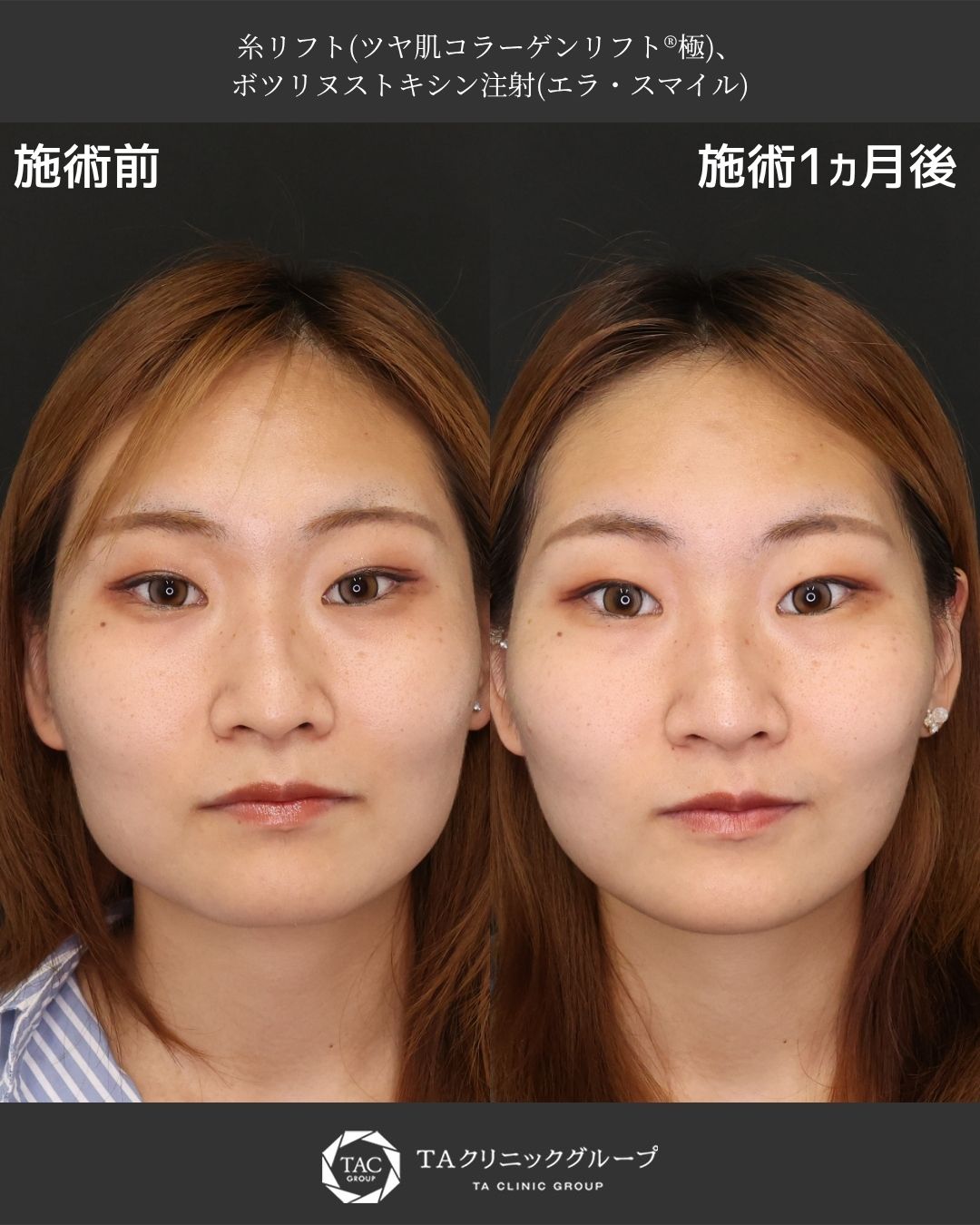 【糸リフト×ボトックス】エラ張り・余白感を改善、スッキリと引き締まった美しい輪郭へ