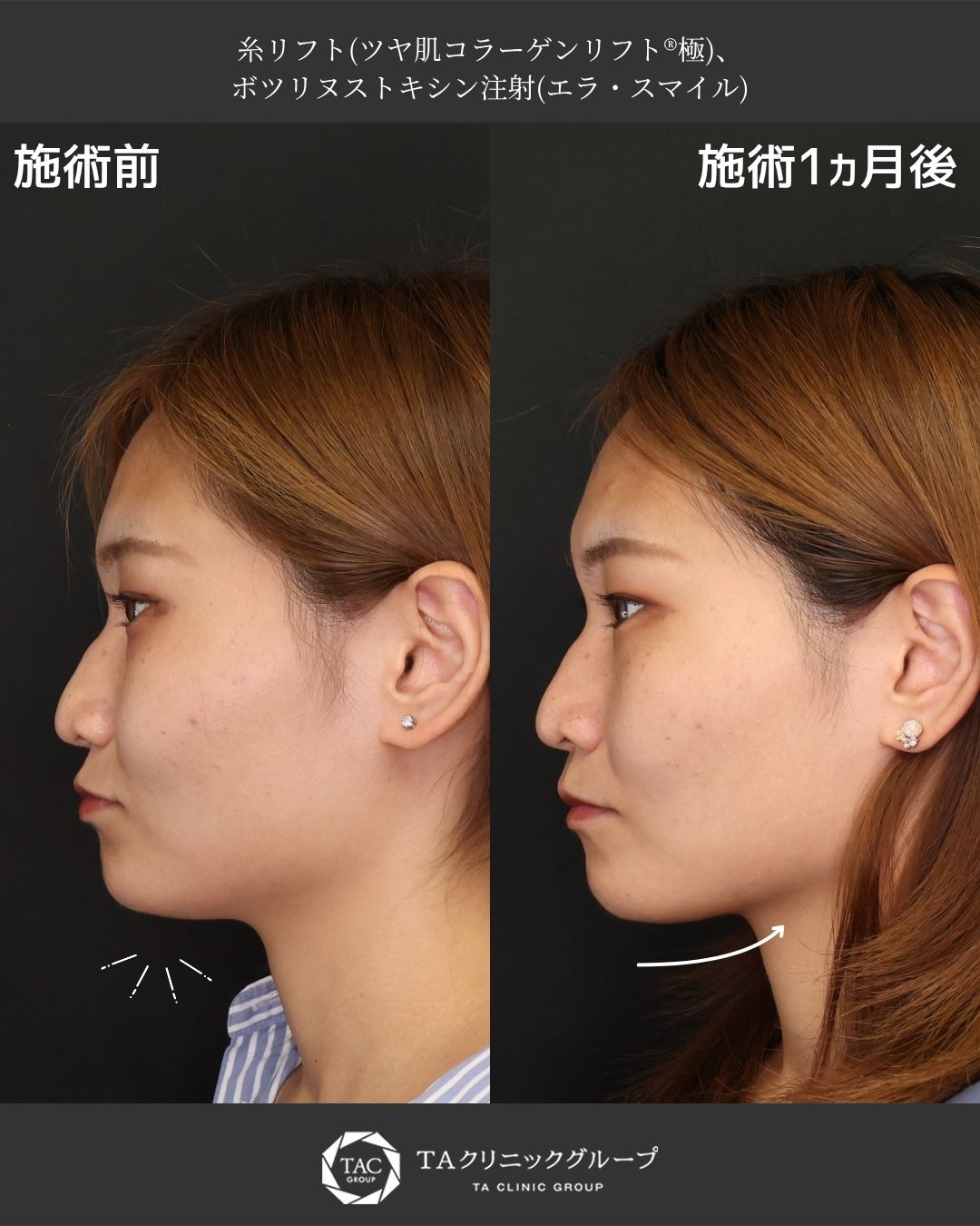 TAC式 ツヤ肌コラーゲンリフト®/エラボトックス注射/ボトックス注射：その他の症例写真 施術前後 