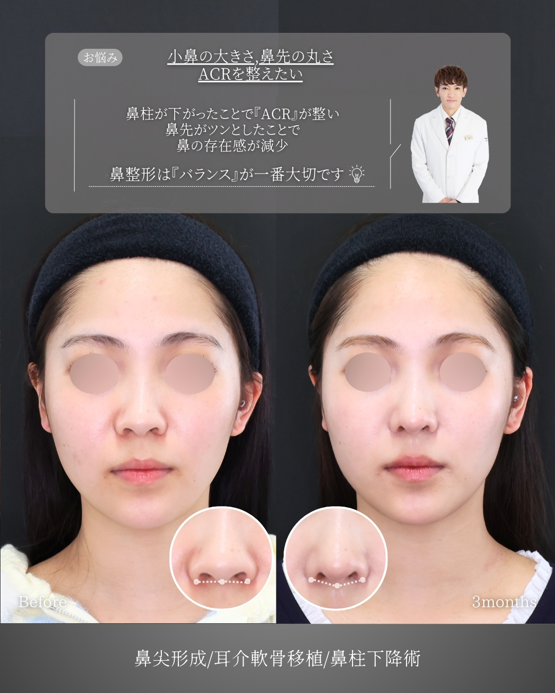 鼻尖形成・鼻尖縮小/鼻先軟骨移植の症例写真 施術前後 