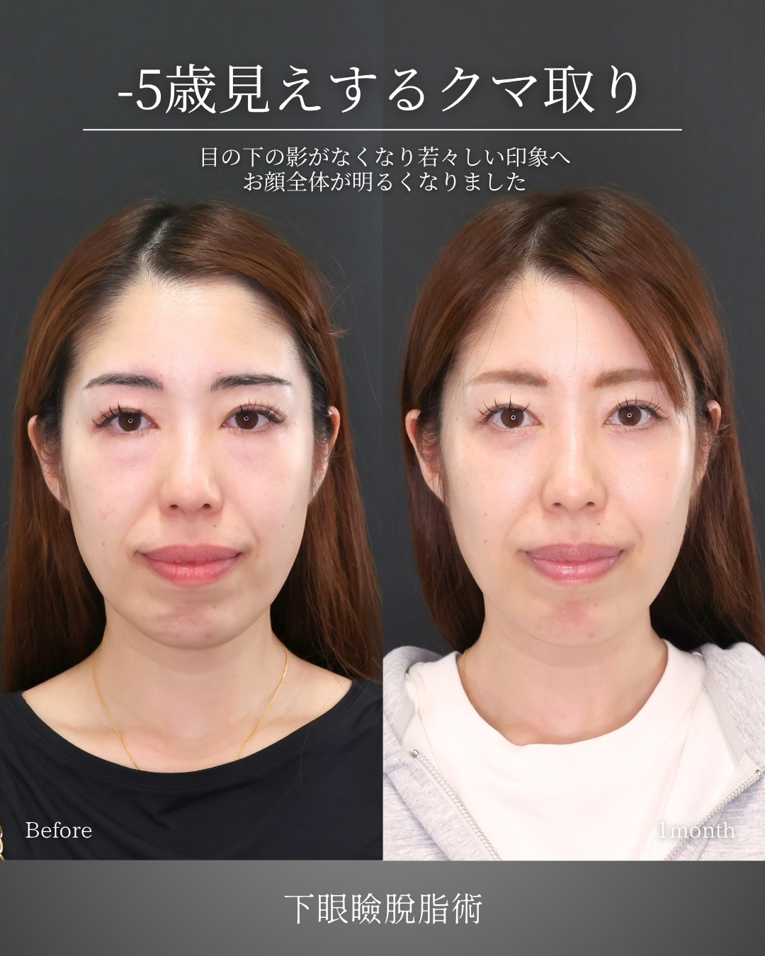 下眼瞼脱脂術（目の下のたるみ取り・目の下の脂肪ふくらみ取り）の症例写真 施術前後 