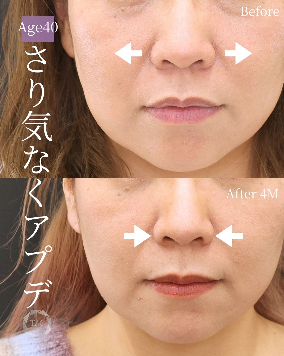 TAC式 鼻翼縮小術（小鼻縮小）の症例写真 施術前後 