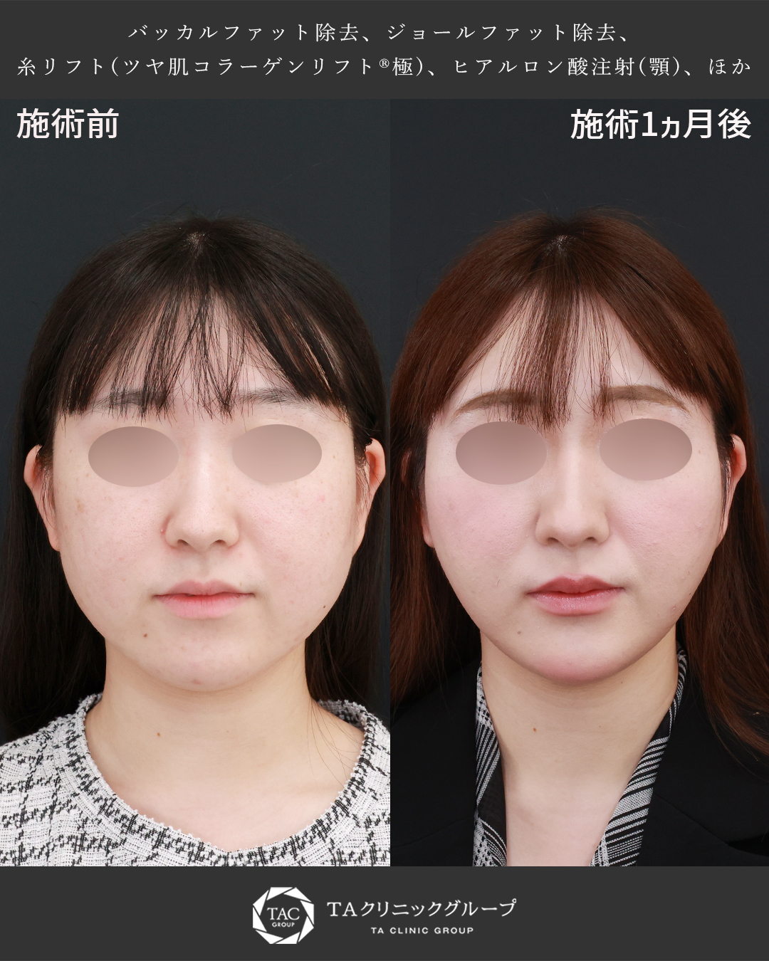 脂肪除去×糸リフトで輪郭すっきり
