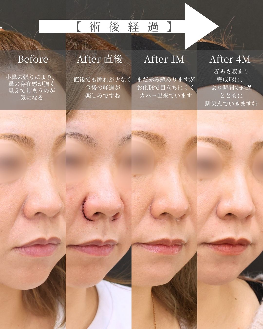 TAC式 鼻翼縮小術（小鼻縮小）の症例写真 施術前後 