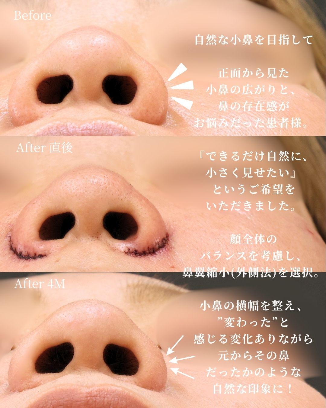 TAC式 鼻翼縮小術（小鼻縮小）の症例写真 施術前後 