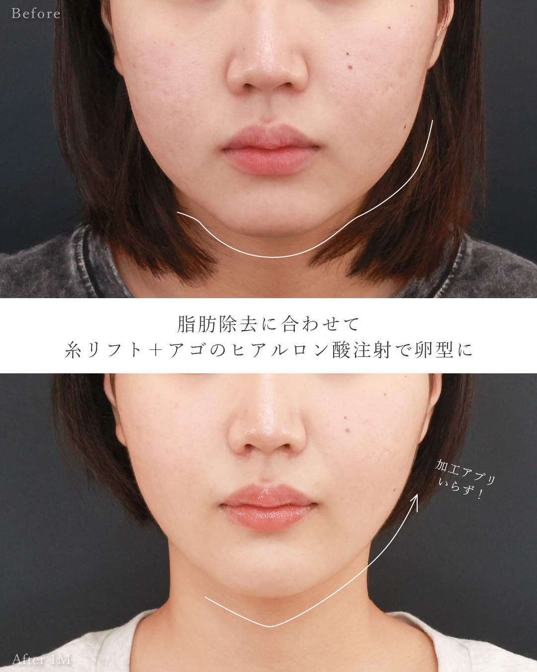TAC式 ツヤ肌コラーゲンリフト®/バッカルファット除去/顎のヒアルロン酸注射の症例写真 施術前後 